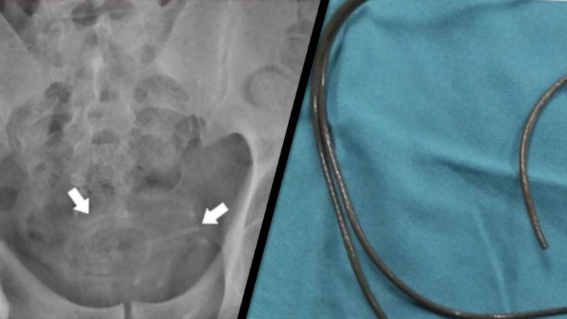 Bloke shoves 80cm-long-earphone wire into his D, rushed to emergency department