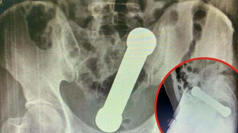 Doctors discover 2kg dumbbell stuck in man’s bum, remove it with hands