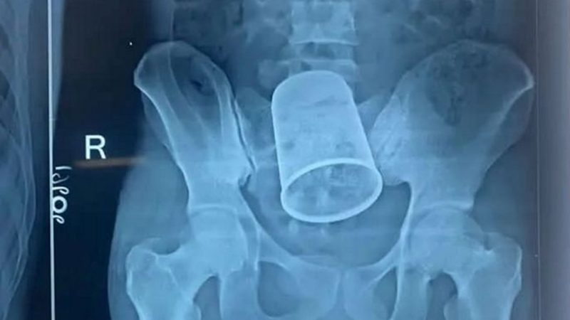 Doctors remove 14-cm-long steel cup from drunk bloke’s anus 