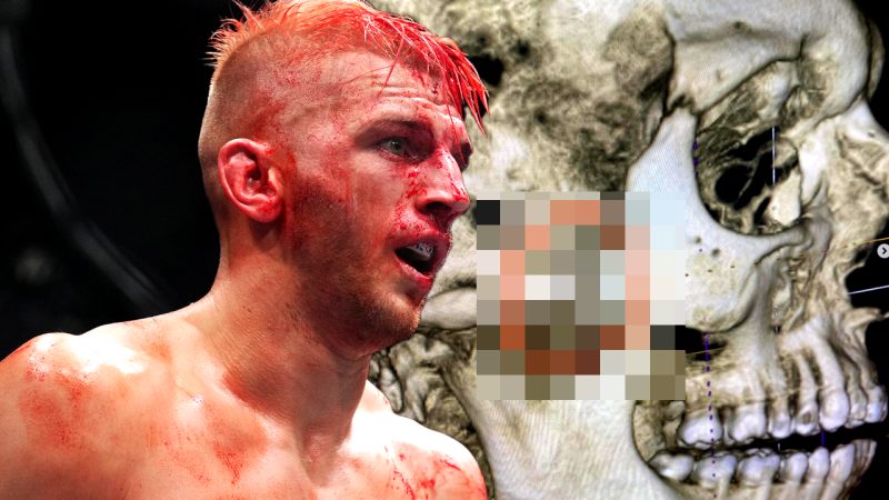 ‘Anudda Scratch’: Kiwi UFC legend Dan Hooker reveals another broken bone from UFC 290 Fight